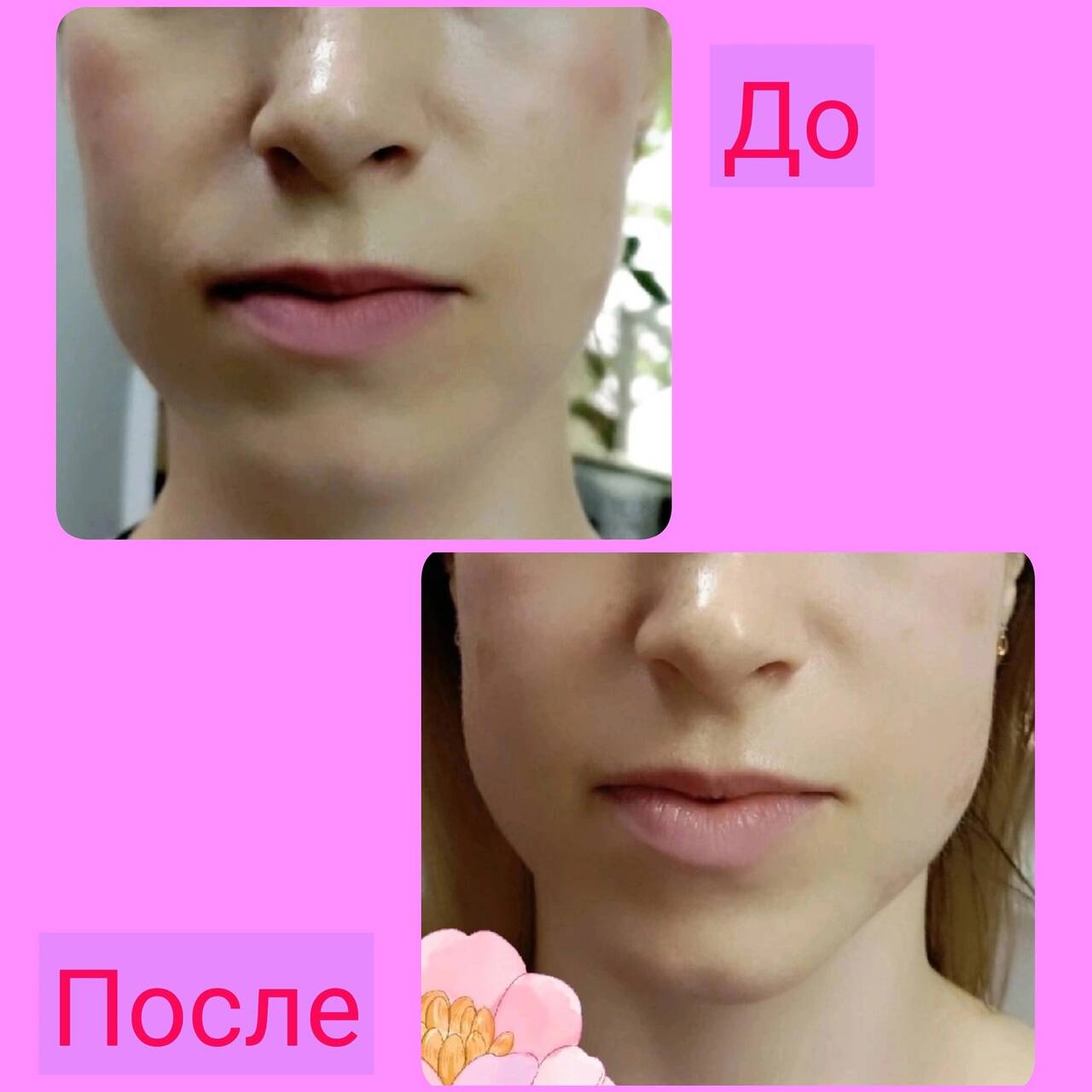 Массаж лица, УЗ-пилинг, микротоки, фонофорез  в Симферополе фото 5 Услуги Симферополь