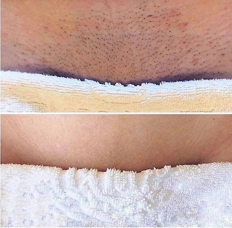 Процедура лазерной эпиляции в нашей студии. в Самаре фото 3 Услуги Самара