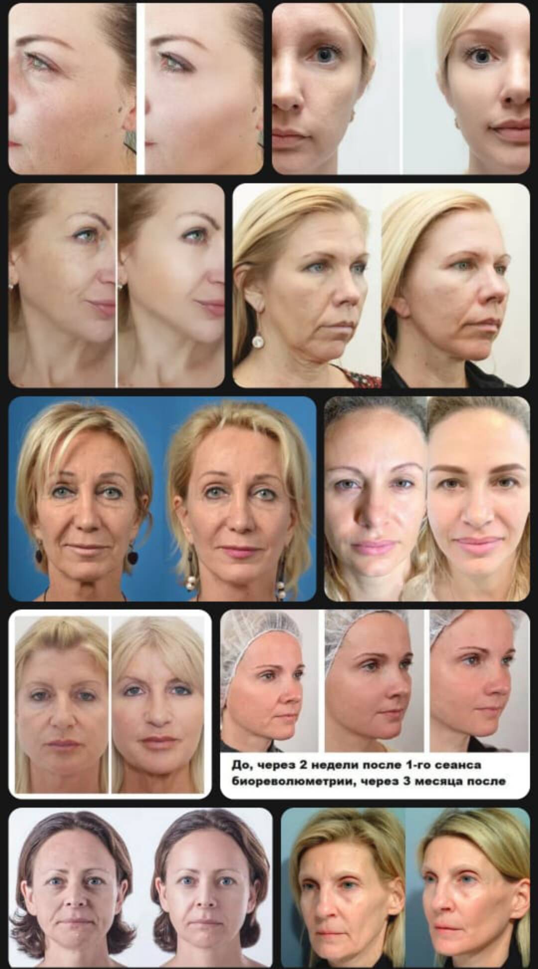 Биоревитализация и Миостимуляция в Москве фото 1 Услуги Москва