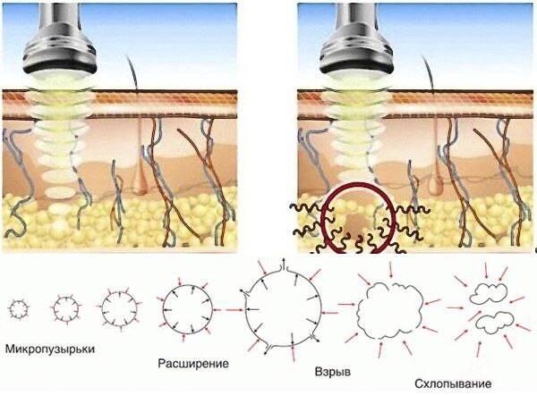 Аппарат LPG в Саках фото 2 Услуги Саки