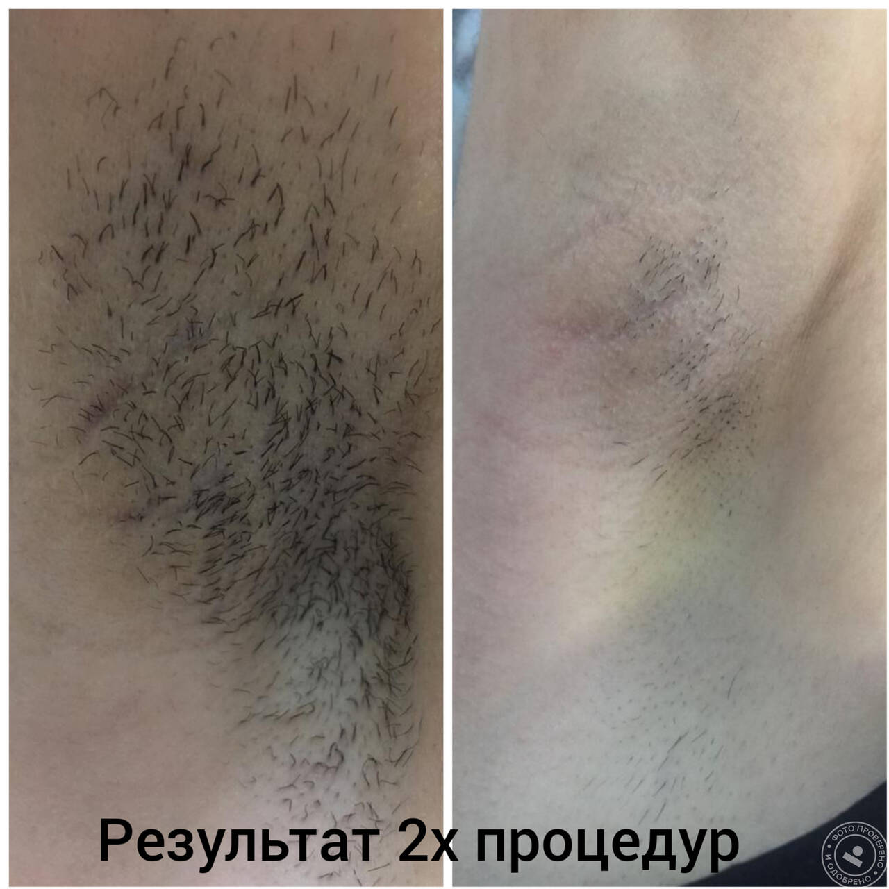 Лазерная эпиляция  в Саратове фото 2 Услуги Саратов