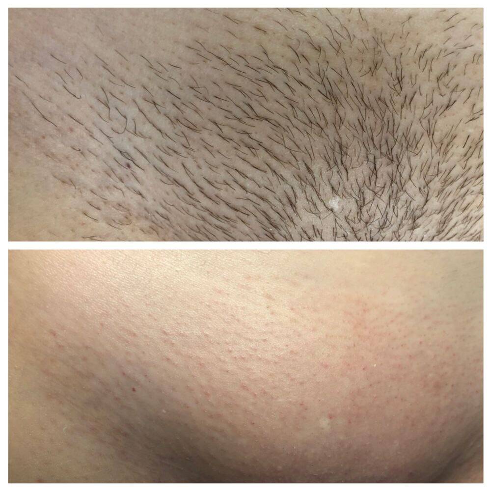 Лазерная эпиляция  в Саратове фото 3 Услуги Саратов