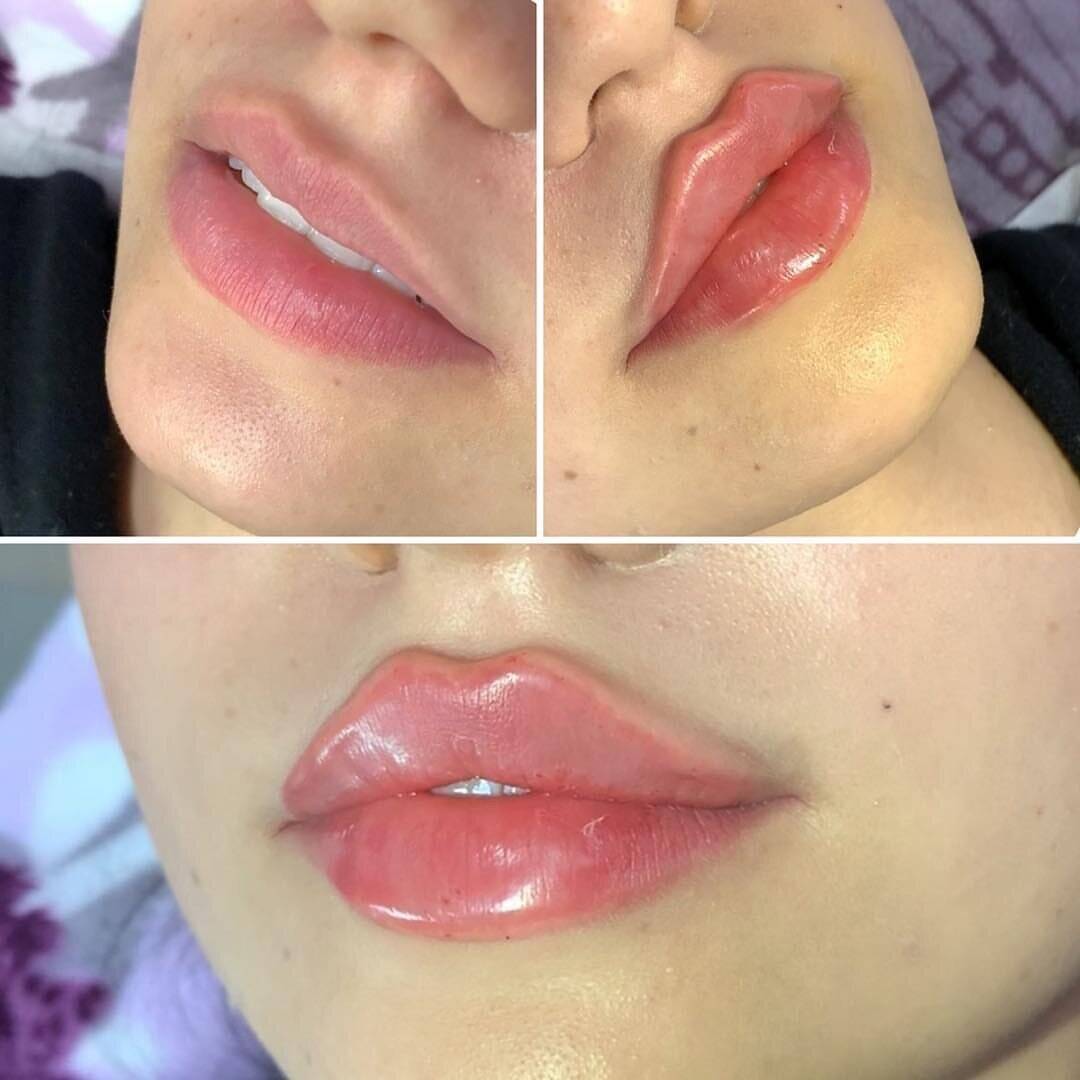 Модель на увиличение губ  в Москве фото 3 Услуги Москва