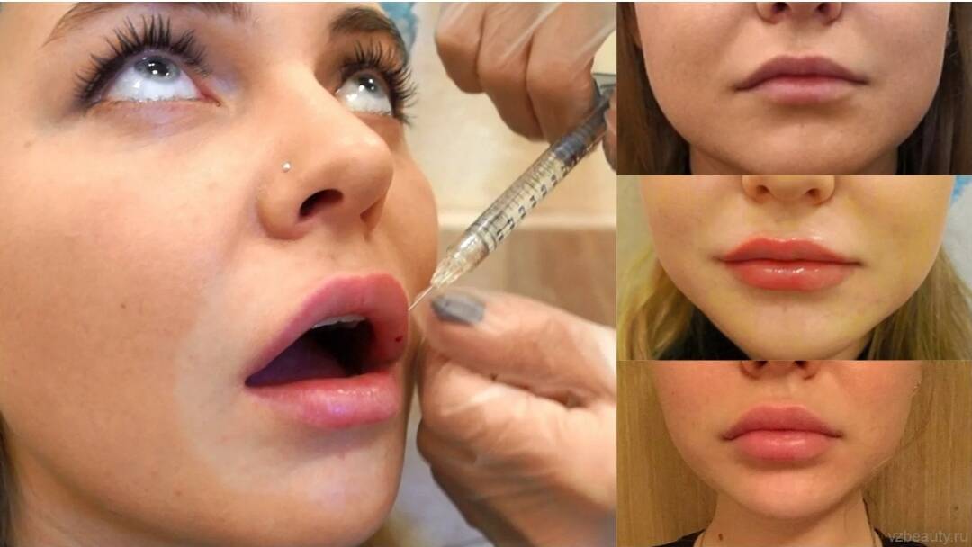 Модель на ботокс и увеличение губ в Москве фото 6 Услуги Москва