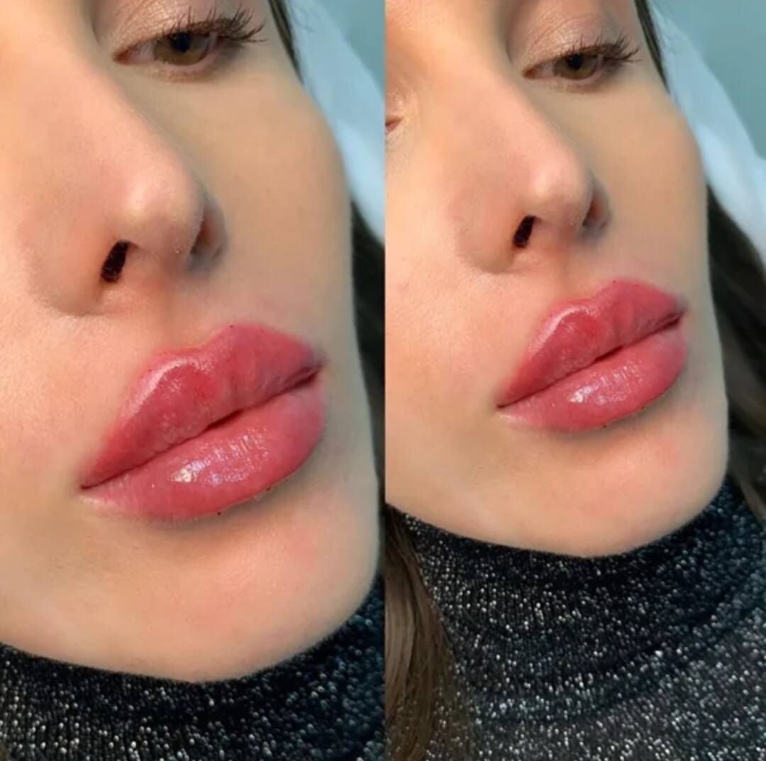 Модель на ботокс и увеличение губ