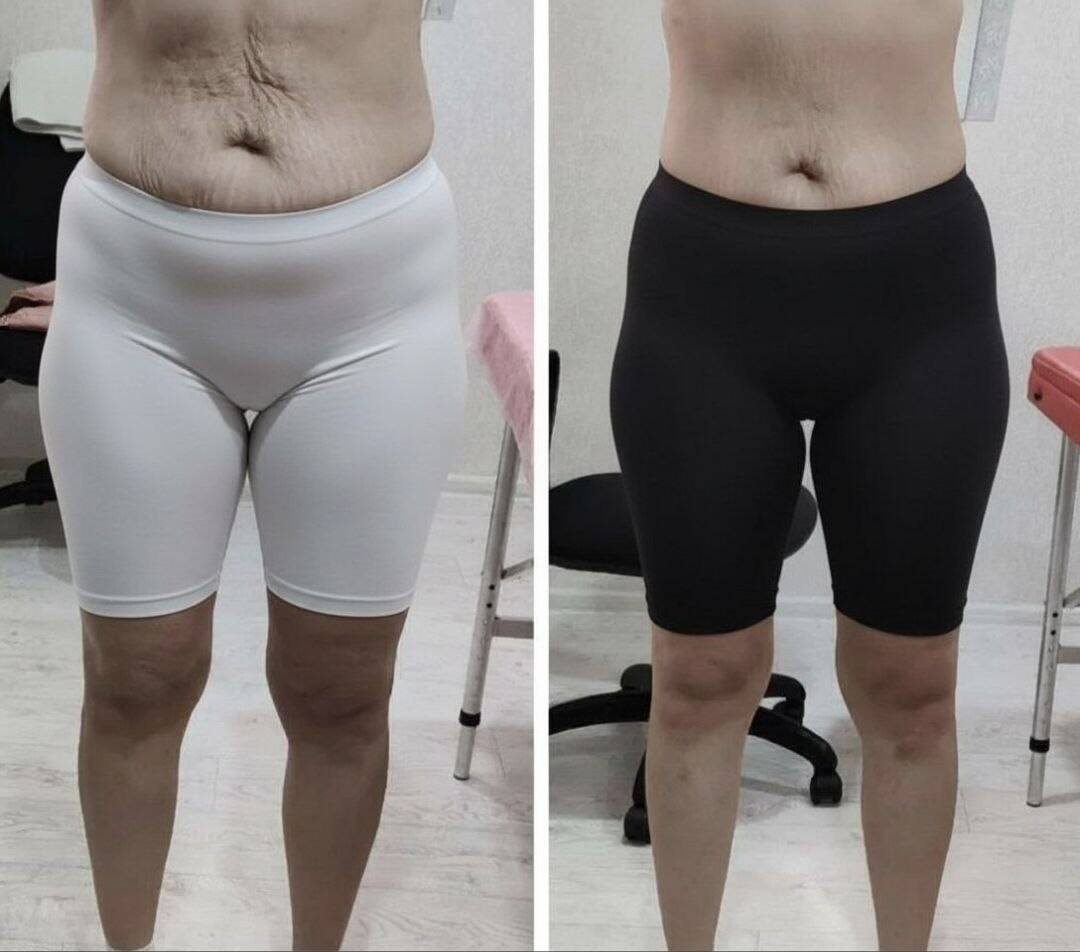 Корекция фигуры  в Старой Купавне фото 4 Услуги Старая Купавна