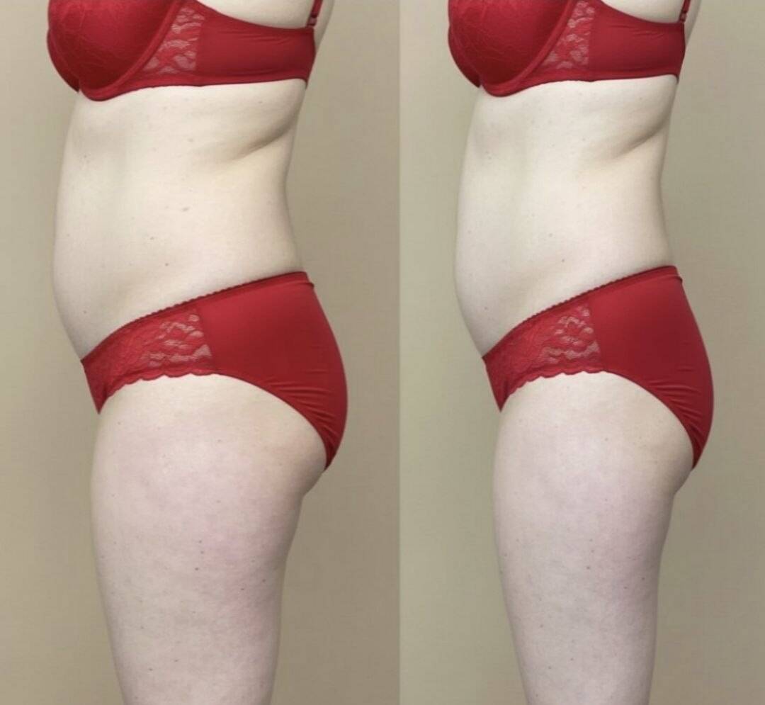 Корекция фигуры  в Старой Купавне фото 5 Услуги Старая Купавна