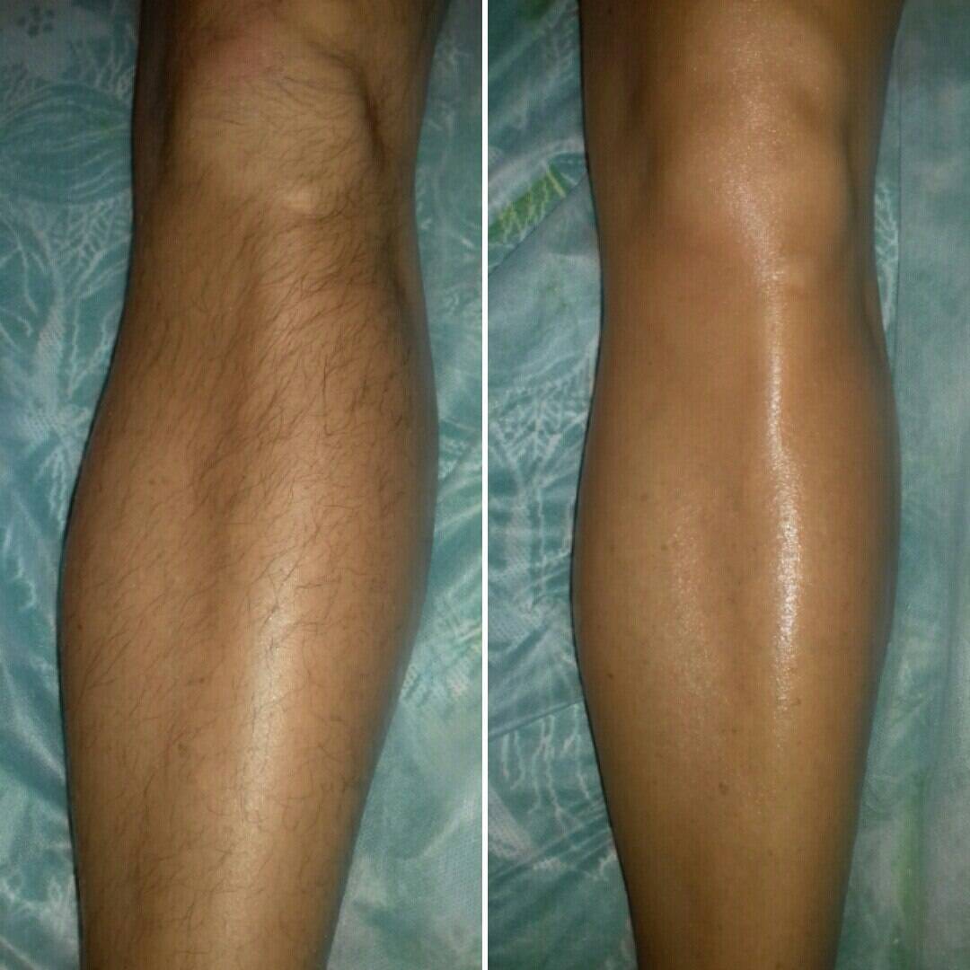 Депиляция в Верхних Печёрах Депиляция в Верхних Печёрах