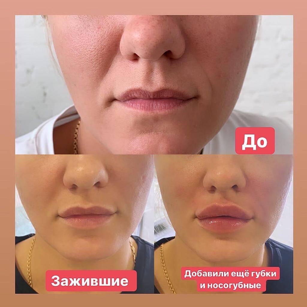 Контурная пластика Липолитики в Одинцово фото 3 Услуги Одинцово