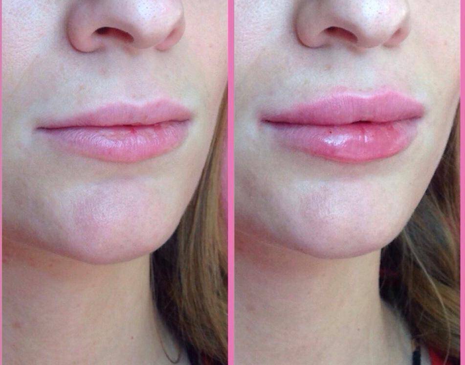 Контурная пластика Липолитики в Одинцово фото 4 Услуги Одинцово