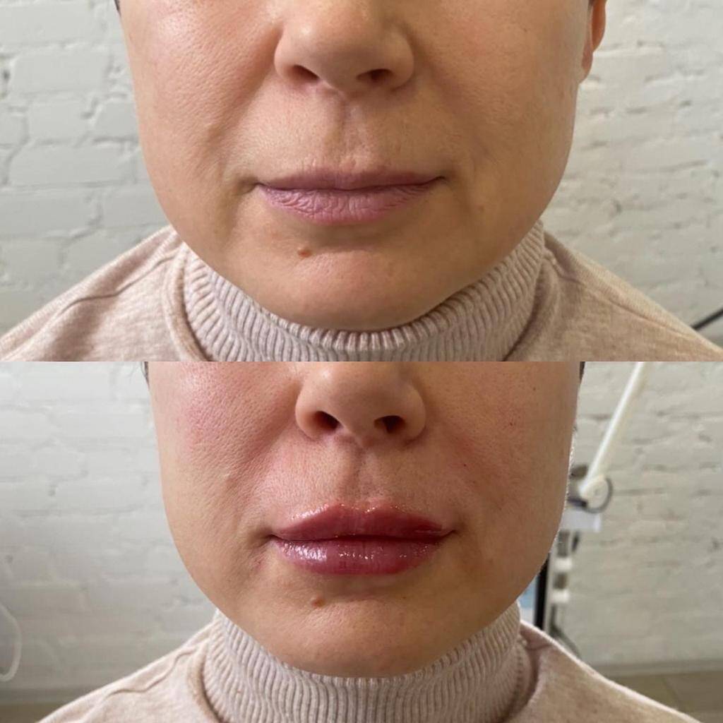 Контурная пластика Липолитики в Одинцово фото 2 Услуги Одинцово