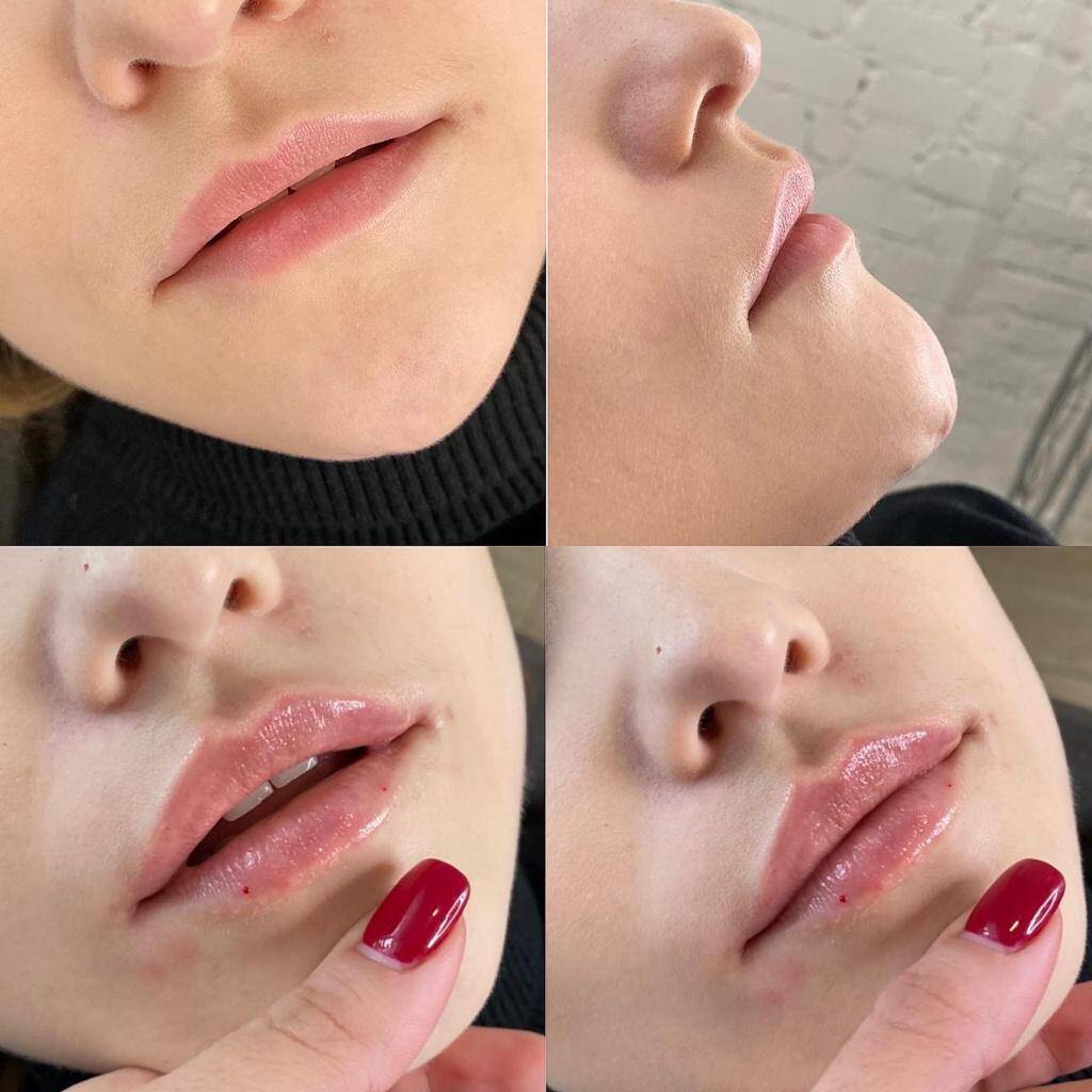 Контурная пластика Липолитики в Одинцово фото 5 Услуги Одинцово