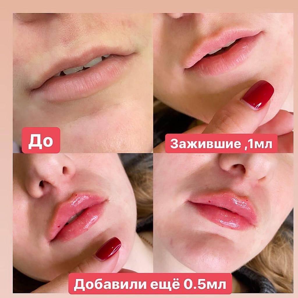 Контурная пластика Липолитики в Одинцово фото 6 Услуги Одинцово