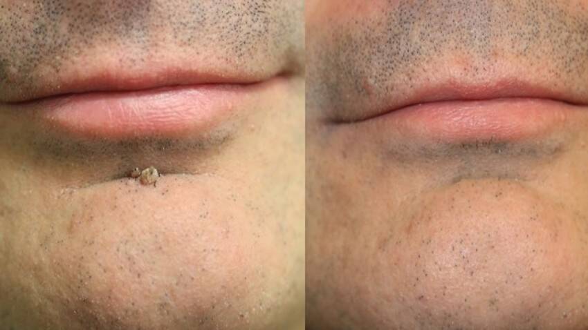 Удаление папиллом