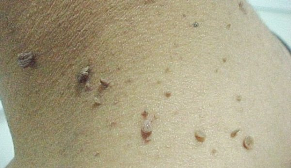 Удаление папиллом в Одинцово фото 3 Услуги Одинцово