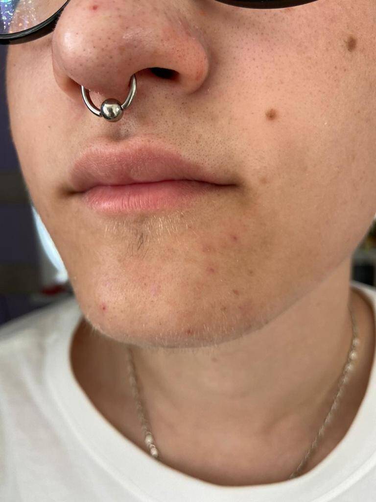 Пирсинг микродермалы восстановление проколов в Одинцово фото 3 Услуги Одинцово